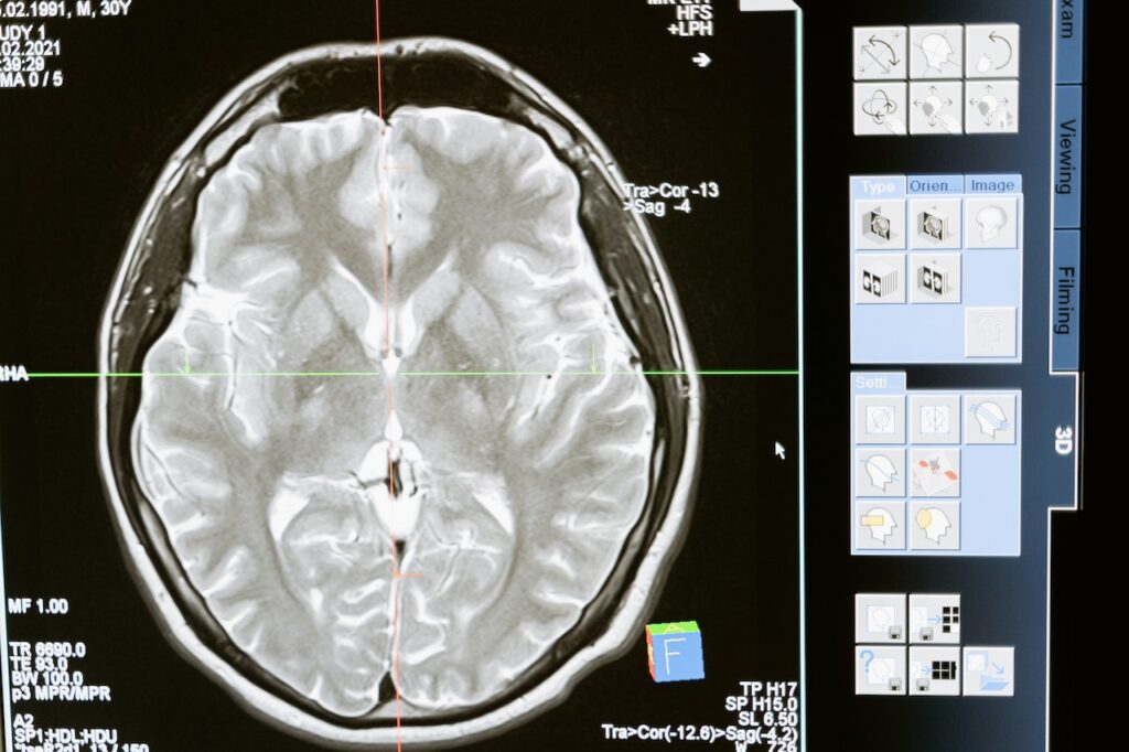 photo of a brain scan